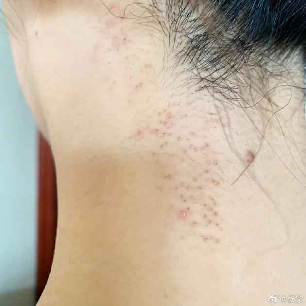 杨紫回应现身整形美容医院：只是去护肤祛个碎发