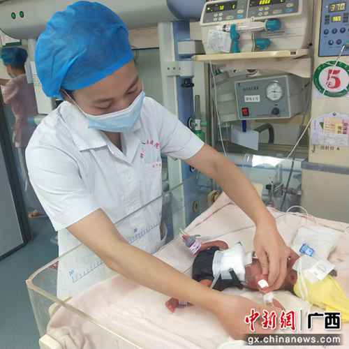 自治区南溪山医院乐成救治一例早产极低体重患儿