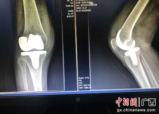 膝枢纽置换术乐成办理81岁老人多年困扰